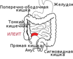 Болезнь Крона лечение