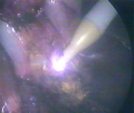 Лапароскопия желчного пузыря семашко thumbnail