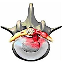 грыжа межпозвоночного диска шейного отдела