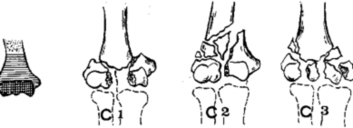 Внутрисуставные переломы плечевой кости классификация