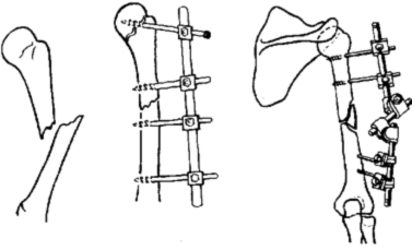 Внутрисуставные переломы плечевой кости классификация