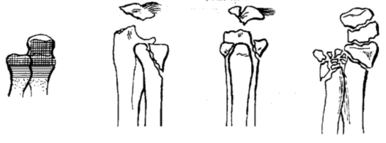 Переломы дистального отдела костей предплечья thumbnail