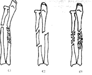 Переломы дистального отдела костей предплечья
