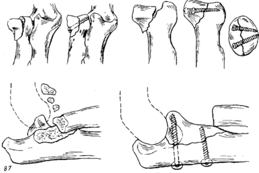 Комбинированные переломы костей предплечья
