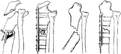 Комбинированные переломы костей предплечья