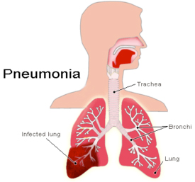 пневмония лечение